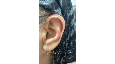 تست غربالگری شنوایی