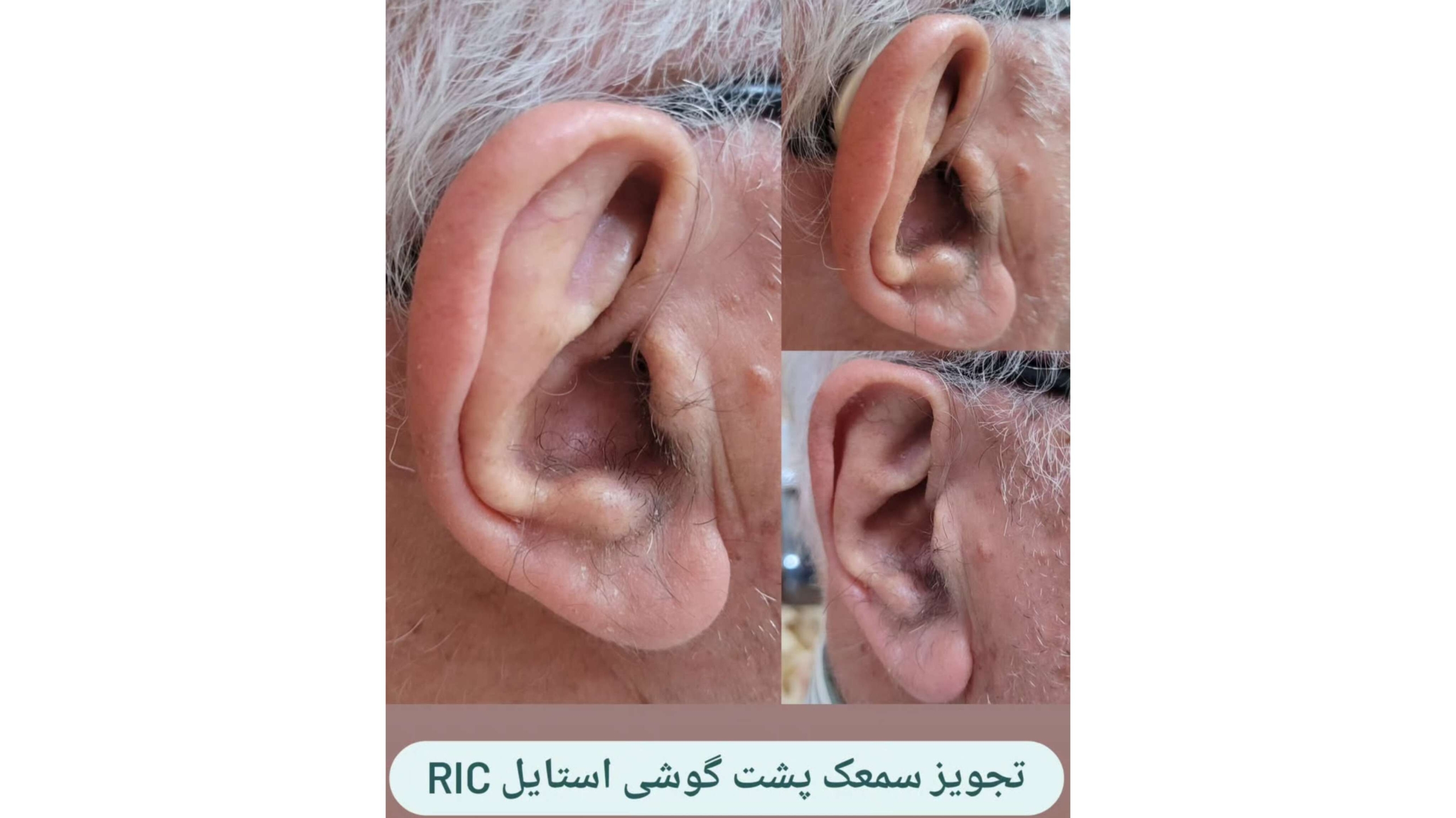 اهمیت غربالگری شنوایی نوزادان 